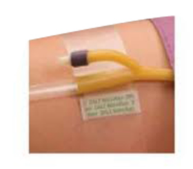 Dale Hold-N-Place® Adhesive Patch Foley Catheter Holder, One Size, Latex-Free